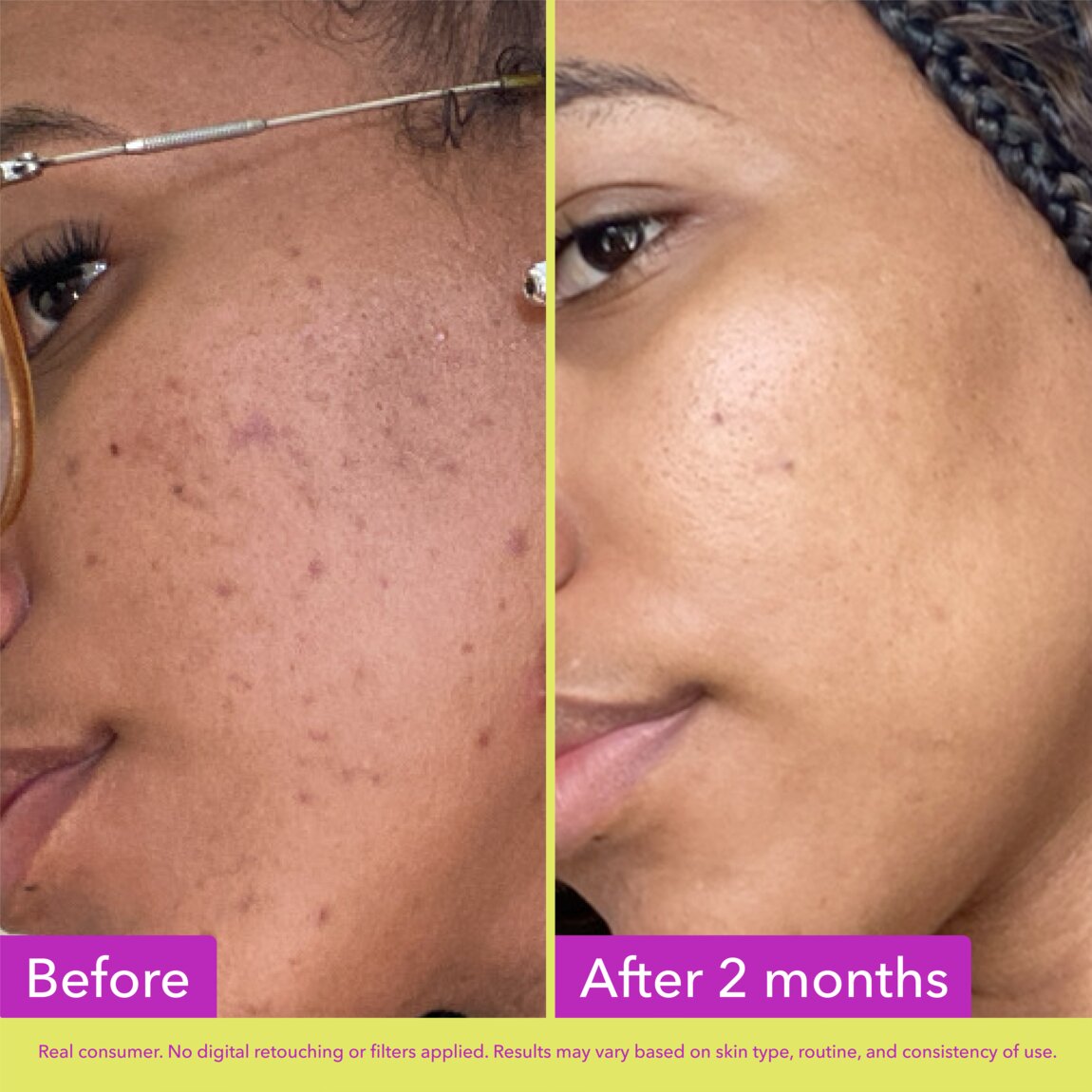 10-azelaic-acid-treatment-m7 zb_p.jpg