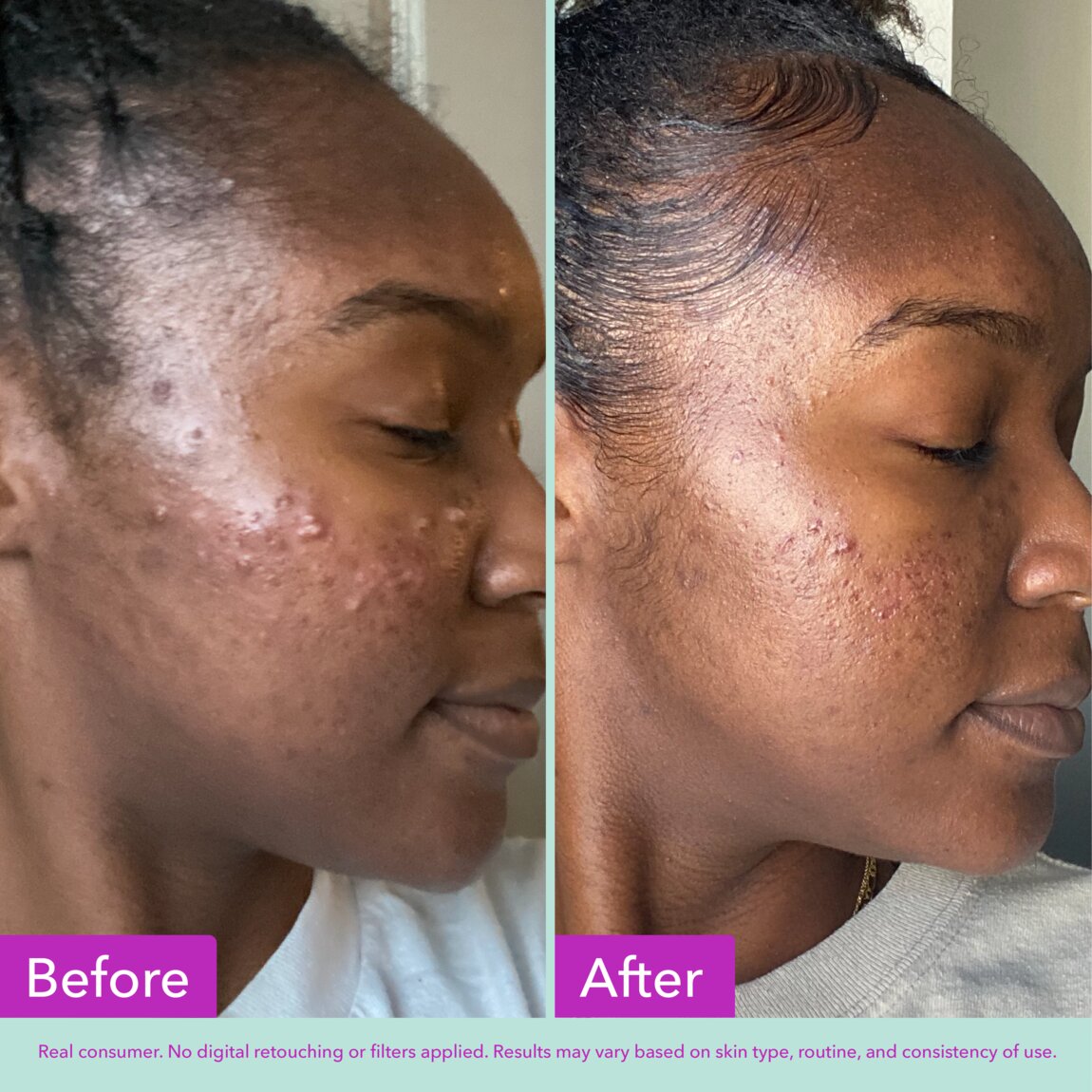 acne-foaming-cleanser-h2 zb_p.jpg