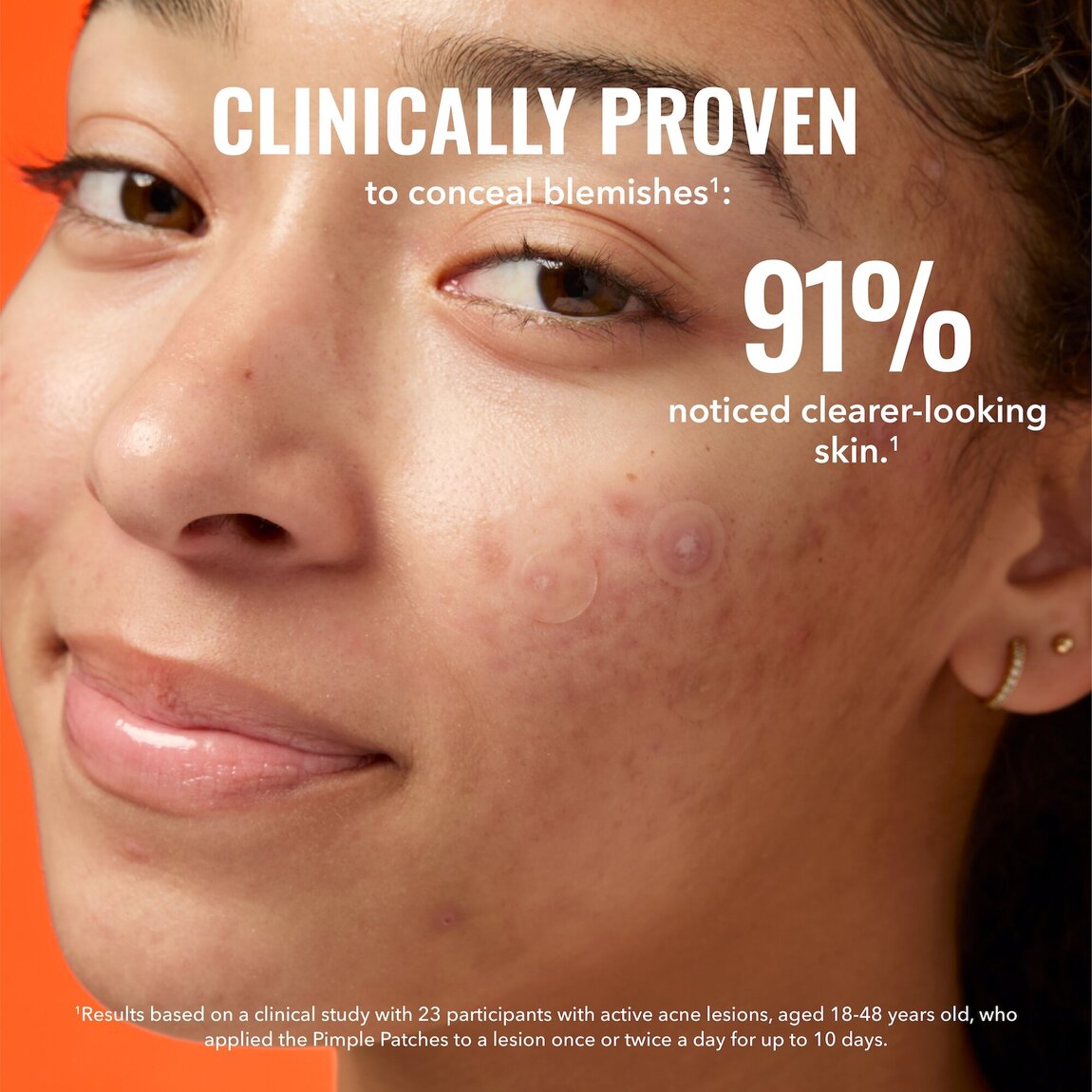 pimple-patches-x5 zb_p.jpg